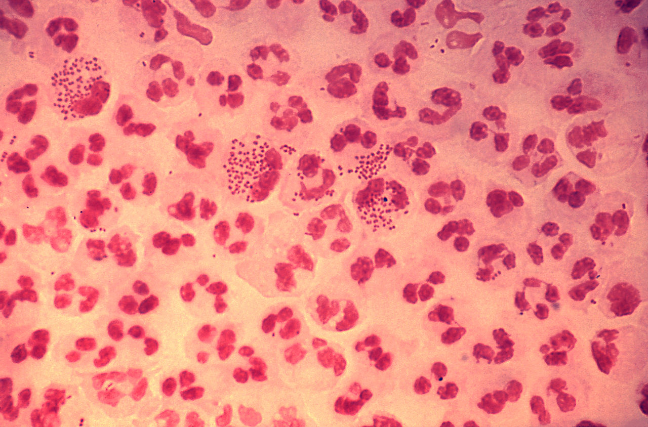 Gram-gefärbte Neisseria gonorrhoeae aus einem Harnröhrenabstrich